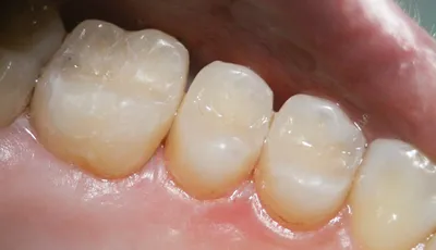Глубокое фторирование зубов что за процедура