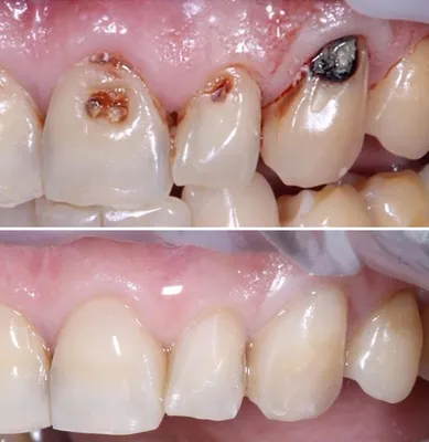 Реставрация зубов (до и после) - Работы стоматологов Центра Стоматологии и  Имплантологии