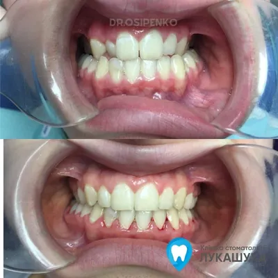 Дистопия зуба до/после в Уфе | ☎ +7 (347) 295-94-77