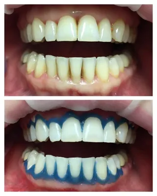 💊 Удаление зубов и последующая имплантация метро Таганская Марксистская в  стоматологической клинике Vitart