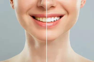 Эффективно ли серебрение зубов детям? | Семейная стоматология