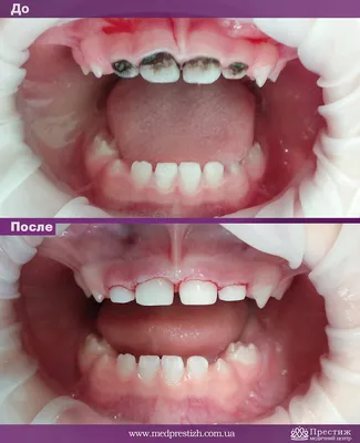 Серебрение молочных зубов - Стоматологическая клиника – SiriusDent