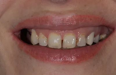 Реставрация (восстановление) молочных зубов в Киеве - Baby Smile