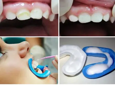 Коллеги,подскажите,чем вы делаете реставрации молочных зубов после серебра? Серебрение проводилось препаратом Saforide | ВКонтакте