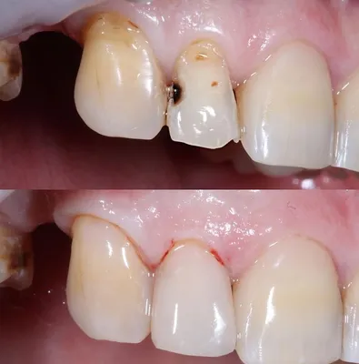 Серебрение: как метод лечения начальных форм кариеса | У зубного | Дзен