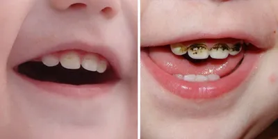 Реставрация зубов (фото до и после) - Работы стоматологов Центра  Стоматологии и Имплантологии