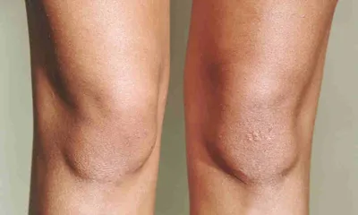 Шелушение кожи на коленях фото фото