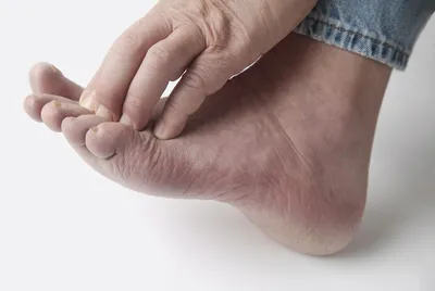 Сухость и шелушение ног: как справиться с проблемой 💗 professionals.beauty