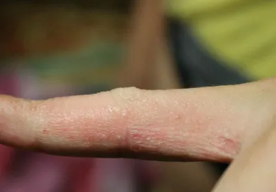 Уход за кожей ребенка ‒ что делать, если трескается кожа на руках?