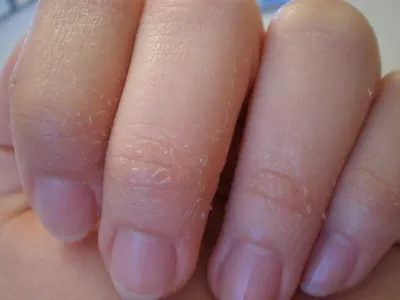 Почему у ребенка облазит кожа на пальцах рук?