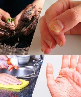 Трещины на пальцах: причины появления, как лечить, профилактика появления.