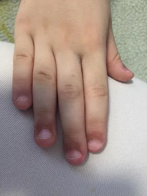 Ребенок 7,5 лет, после гриппа и антибиотиков на пальцах рук облезла вся кожа,  болит. На что это похоже? - Я happy MAMA