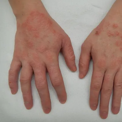 Аллергический контактный дерматит - лечение, клинические рекомендации,  причины