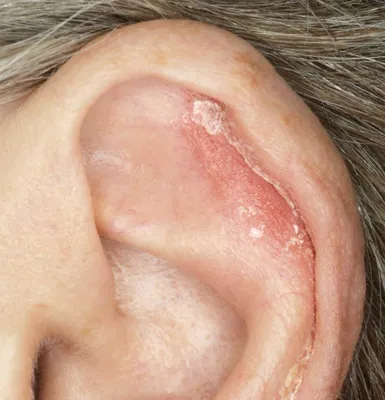 Почему шелушится кожа в ушах - причины и лечение