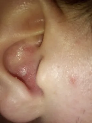 Шелушение и сухость кожи в ушах - Вопрос дерматологу - 03 Онлайн