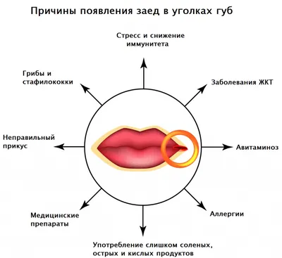 Bonjour_almaty - СОМНЕВАЕТЕСЬ, НУЖНА ЛИ ВАМ ПРОЦЕДУРА УВЕЛЕЧЕНИЕ ГУБ💋💉? ⠀  Процедура показана в следующих случаях: ⠀ 👄тонкие, узкие губы; 👄явно  выраженная асимметрия; 👄сухость и шелушение кожи губ; 👄опущенные уголки  рта; 👄складочки и