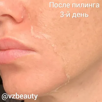 Шелушение после пилинга фото фото