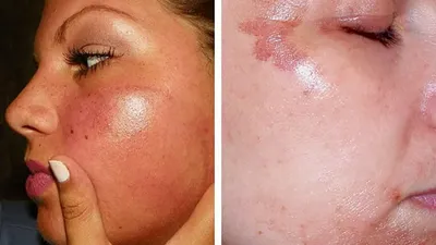 DERMAQUEST » Как убрать ожоги и красноту после пилинга| Статьи | Отзывы |  Купить