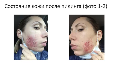 Shop.Medispa - ❗️Так выглядит ваша кожа примерно: 1 фото: на 3 день после  химического пилинга 2 фото: на 8-10 день, когда уже завершилась активная  фаза эксфолиации и сформирован новый слой кожи .