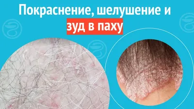 Что делать, если шелушится кожа ≡ Блог MED CITY | Как быстро убрать  шелушение кожи в Киеве