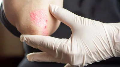 Шелушение кожи - причины появления, симптомы заболевания, диагностика и  способы лечения