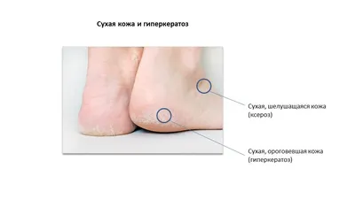 Шелушится кожа на ногах: причины появления шелушения, сухости, зуда стоп и  пальцев, лечение микоза