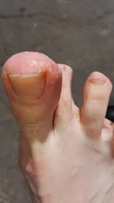 Шелушится кожа на ногах и пальцах - Вопрос дерматологу - 03 Онлайн