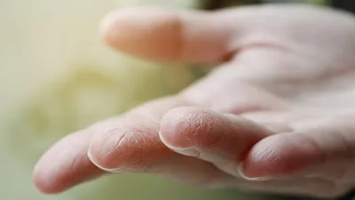 Трескается кожа на пальцах рук и ног: почему трескается у взрослых и чем  это лечить
