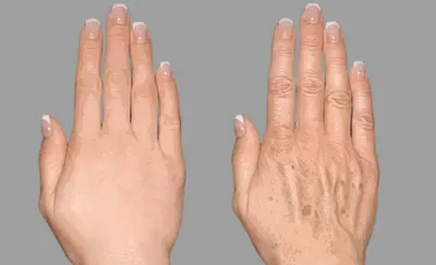 Сухая кожа рук: по каким причинам возникает сухость и как с ней бороться