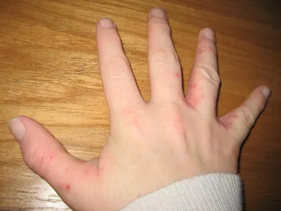 Что делать с сухой кожей на пальцах рук и подушечках.