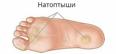 🌸Натоптыш или сухая мозоль – это уплотнение верхнего слоя кожи на ступнях  ног. Он возникает в результате разрастания ороговевших тканей в… | Instagram