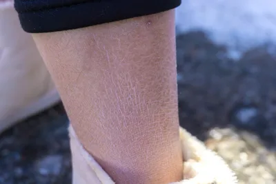 Как избавиться от шелушения кожи на коленях