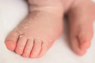 Шелушение кожи у новорожденных — 2 ответов | форум Babyblog