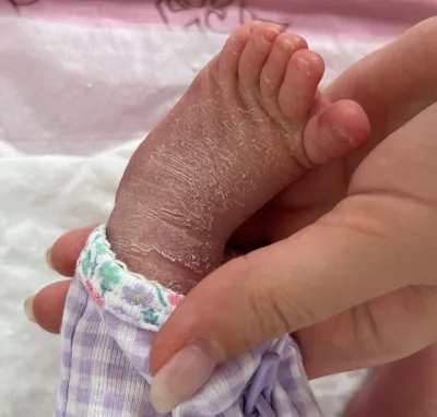 Шелушится кожа у новорожденного (с фото) — 26 ответов | форум Babyblog
