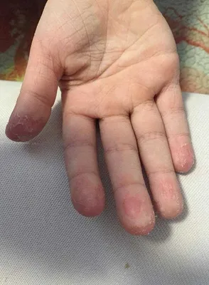 У ребенка шелушится кожа на пальцах рук