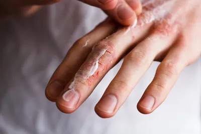 Уход за кожей ребенка ‒ что делать, если трескается кожа на руках?