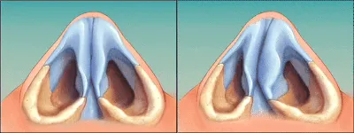 Искривление перегородки носа - клиника ЛОР Центр