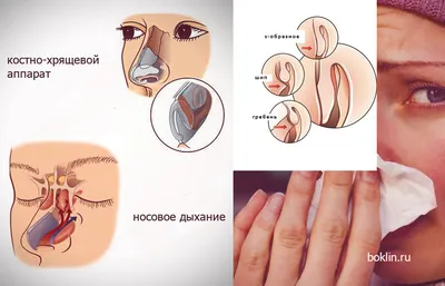 Искривление носовой перегородки. Годность к ВС | ВКонтакте