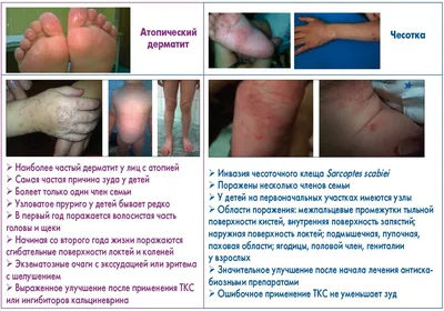 Сыпь на ногах она разделена на кучки - Вопрос детскому дерматологу - 03  Онлайн