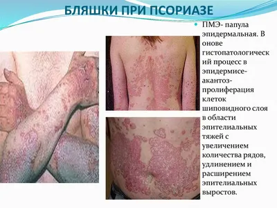 Лечение пузырчатки (пемфигуса) в Киеве — Derma.ua