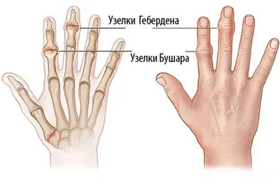 Ревматоидный артрит рук: лечение и симптомы - статьи от компании Еламед