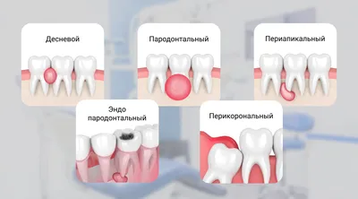Шишка на десне после удаления зуба - Стоматология Северное Бутово Делия  только качественные услуги