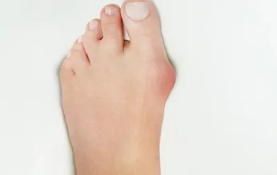 Шишка на ноге: причины, диагностика и методы лечения косточек на пальцах