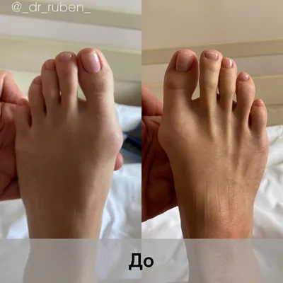 Лечение косточки на ноге у большого пальца: как убрать шишку на стопе