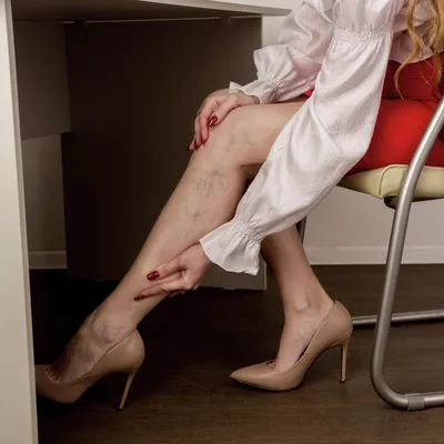 Шишка на ноге, на большом пальце: удаление косточки, как избавиться |  Beauty Insider