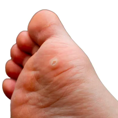 Почему немеет большой палец на ноге | основные причины, симптомы и методы  лечения