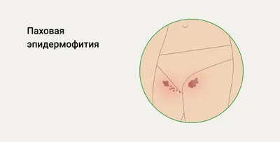 Как бороться с вросшими волосами, как убрать вросшие волосы на ногах —  Medicalaser