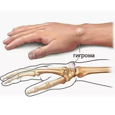 Воспаление лимфоузлов под мышкой - причины, симптомы и методы лечения