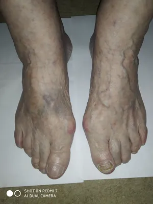 Вальгусная деформация (Hallux valgus) – причины, стадии, классификация и  лечение в «Будь Здоров»