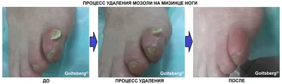 Hallux Valgus / Вальгусная деформация первого пальца стопы - «Самый  подробный отзыв про операцию и восстановление!В конце отзыва ссылка на  отзыв про удаление винтов и видео послеоперационной гимнастики!» | отзывы